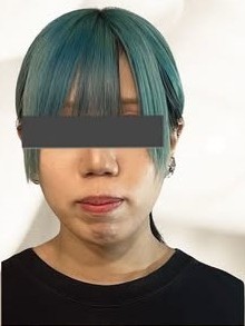 施術前